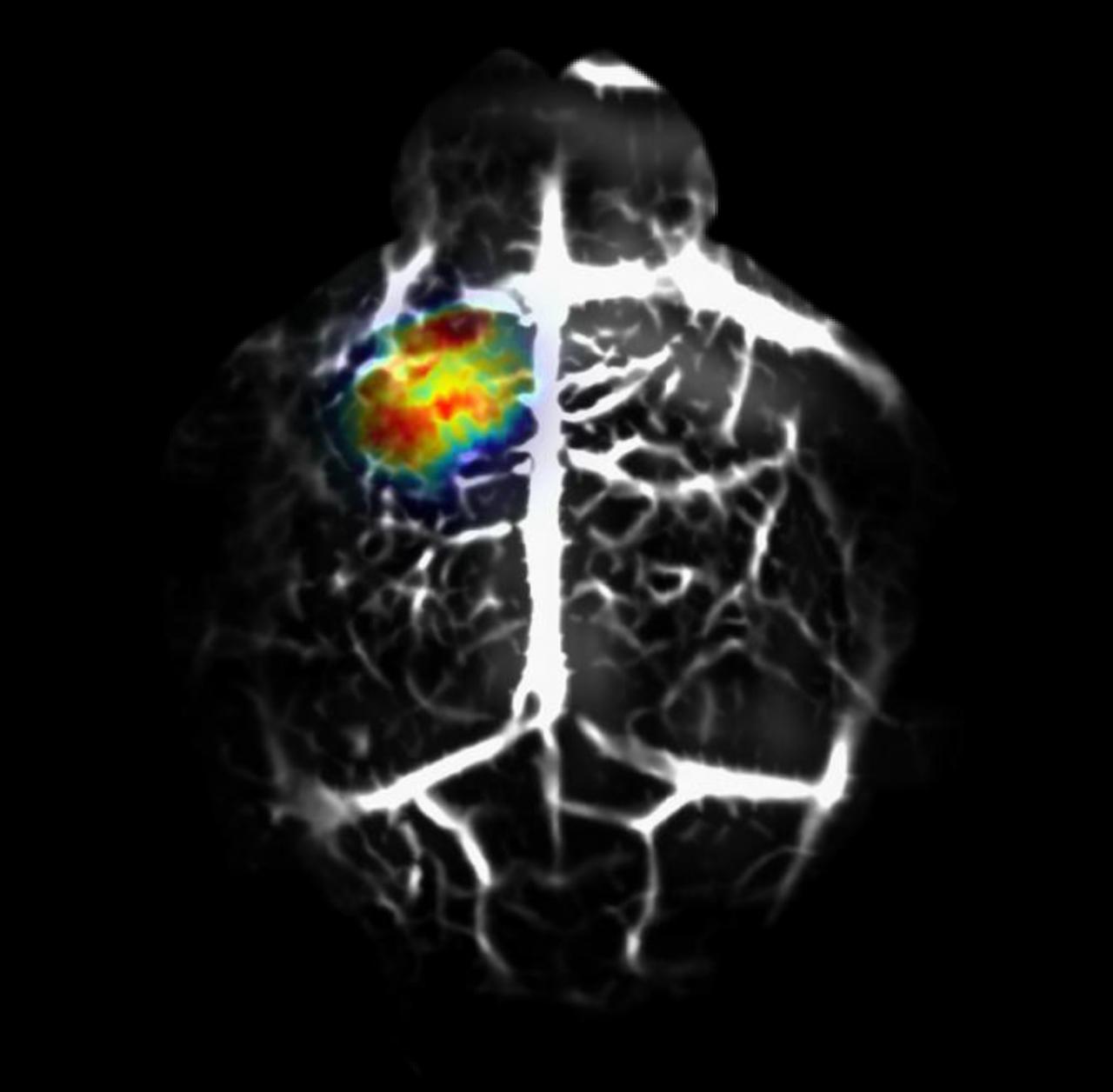 Photoacoustic molecular imaging of brain tumor